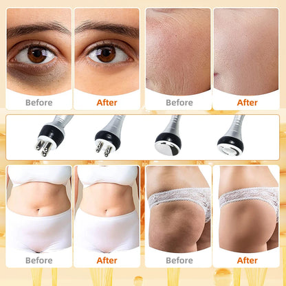 Cavitation Machine Liposuction, Skin Tightening
